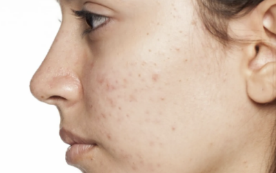 Does dairy cause acne? Debunking all the lies we’ve been told about our skin